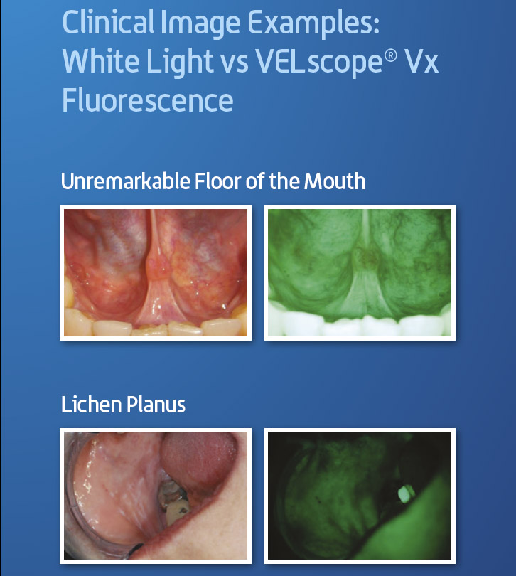 Velscope lampa
